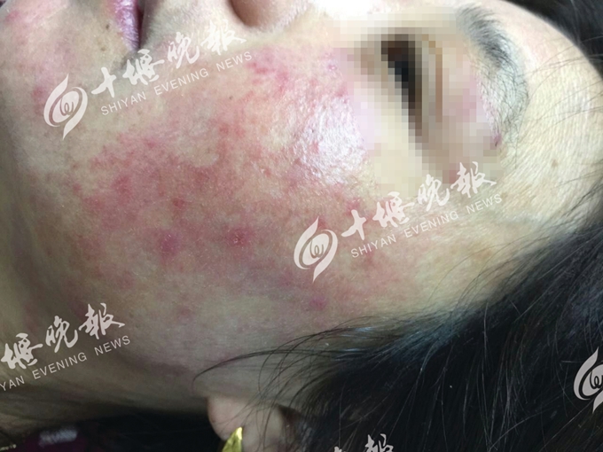 女子发病时满面红斑,丘疹,脓疱.